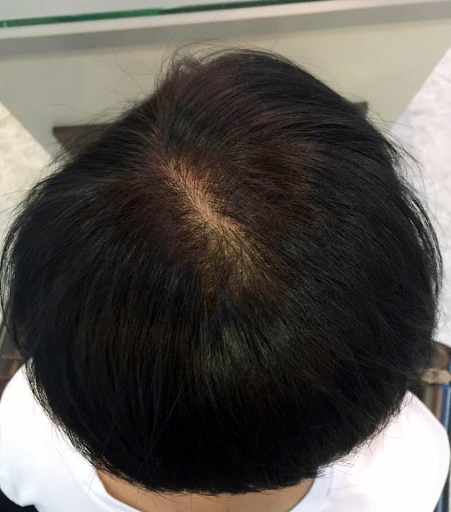 Finding Your Perfect Match: How to Select the Best Scalp Treatment for Hair Loss Finding Your Perfect Match: How to Select the Best Scalp Treatment for Hair Loss